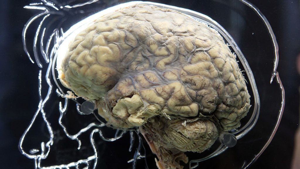 A real human brain being displayed as part of an exhibition at the @Bristol attraction in Bristol, England. Researchers are working on reducing the impact of strokes on human brains through the use of electrical currents. File photo (Matt Cardy/Getty Images)
